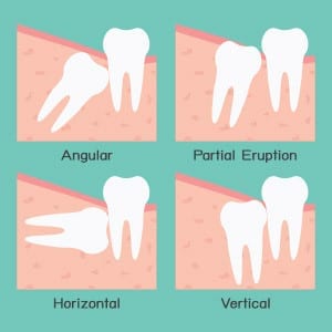 wisdom-teeth-impacted-partially-erupted-300x300